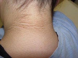 da dày lên và sậm màu ở vùng quanh cổ