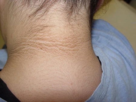 da dày lên và sậm màu ở vùng quanh cổ